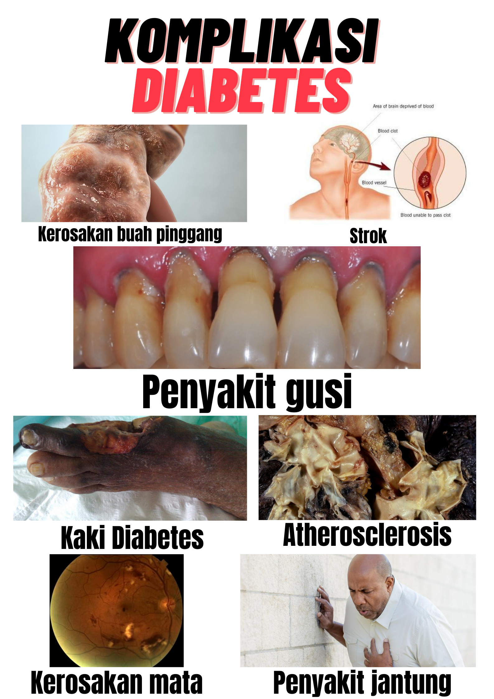 Komplikasi Diabetes